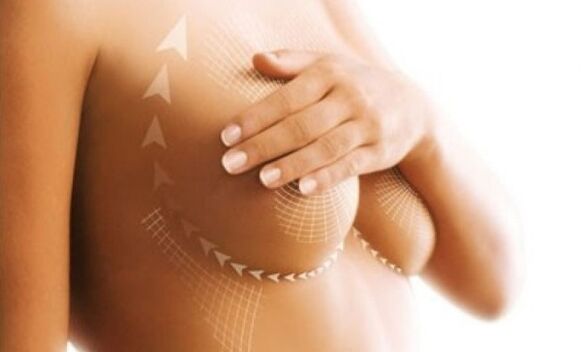 Suture lift pour l'augmentation mammaire