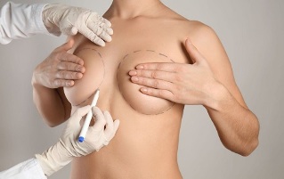 Méthodes d'augmentation mammaire avec chirurgie