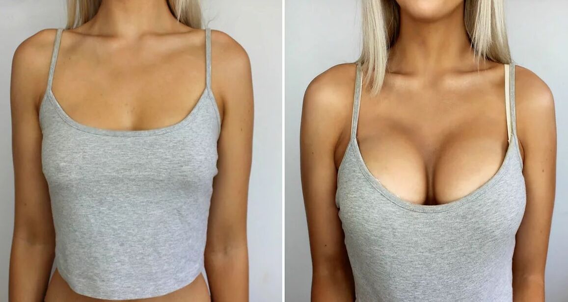 Augmentation mammaire 3 taille