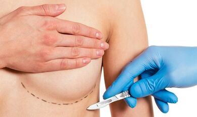 Accès sous-dynamique à l'élargissement du sein avec les implants