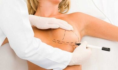 Comment augmenter le caissier des implants