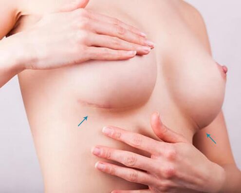 Augmentation mammaire avec implants