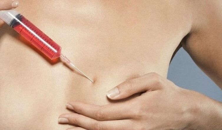 Augmentation mammaire avec injections d'acide hyaluronique