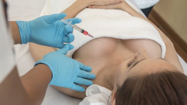 Augmentation mammaire avec de l'acide hyaluronique