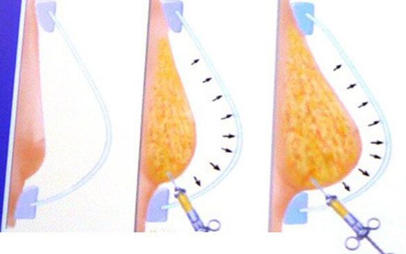 Augmentation mammaire avec de la graisse